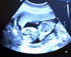 ne zaman başlar hamilelik belirtileri İlk Ay ve Hafta Hamilelik Belirtileri Nelerdir, Ne Zaman Başlar? gebelik belirtileri