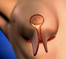 göğüs dikleştirme ameliyatı göğüs dikleştirme ameliyatı, meme dikleştirme ameliyatı, nasıl yapılır, izsiz göğüs dikleştirme Göğüs Meme Dikleştirme Ameliyatı Nasıl Yapılır gogus diklestirme ameliyati