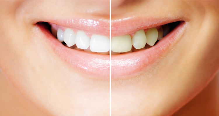 diş beyazlatma yöntemleri nelerdir  Evde Diş Beyazlatma Yöntemleri Nelerdir dis beyazlatma yontemleri nelerdir